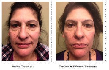 CO2 Fractional Before/After